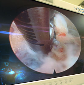 The endoscope removes portions of a herniated disc