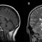 chiari-malformation