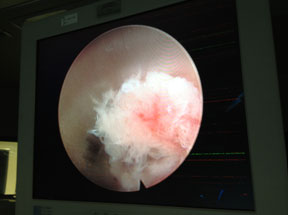 disk-material-through-endoscope disk-material-through-endoscope
