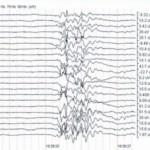 stroke-monitoring