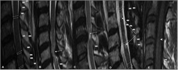 preoperative-mri-mycelopathy