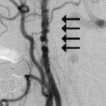 Transient Ischemic Attack