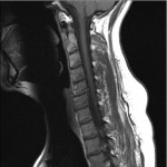 cervical disc