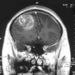 Glioblastoma